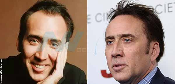 Nicolas Cage hair transplant.